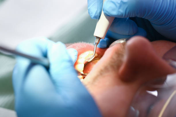 Best Emergency Root Canal Treatment in Riverside, NY